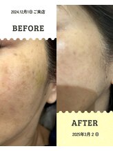 エムズ(M’s)/しみビフォーアフターです