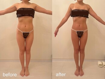 クロレ 浦和店(CLORE)/30代のお客様/5回施術