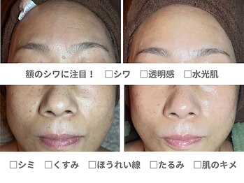 ピュアノア 垂水店/肌質改善フェイシャル　神戸垂水