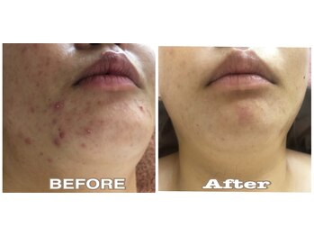 アルページュ(Arpege)/韓国ベビー美肌造り★ニキビケア