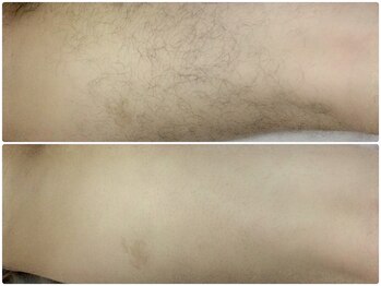 カルム(Calme)/男性 足光脱毛 10代