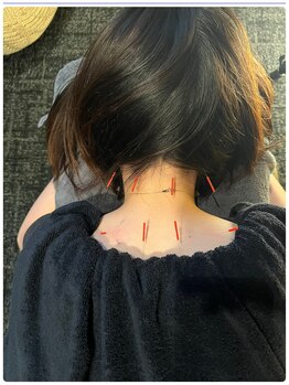 メディカルジャパン 吉祥寺/デスクワークの方による鍼施術