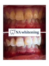 NAホワイトニング 船橋店/ホワイトニングビフォーアフター