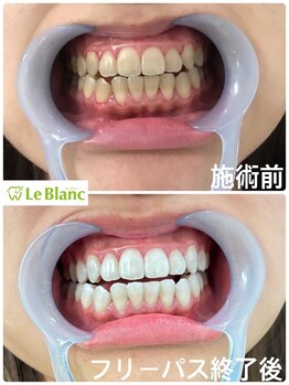 ルブラン 奈良店(Le Blanc)/皆勤賞！！42回照射！