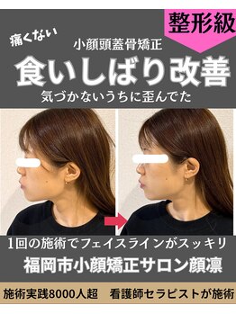 顔凛(カオリン)/食いしばり改善小顔矯正