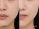 ミネルバ(MINERVA)の写真/年齢サイン（シミ・シワ）に◎！エンダモロジーインフィニティでハリ・ツヤ・弾力のある肌へ☆