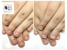 トイロ(toiro)/爪悩みは約7割の人抱えています