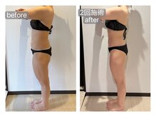 リラ(RILA)/キャビ+マッサージbefore after