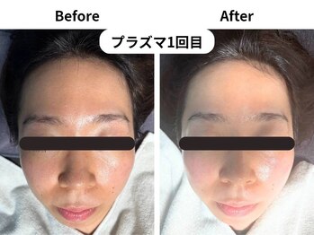 ビー(Be.)/ライトニングプラズマ●1回目