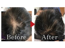 かがわ接骨院 高松伏石院/頭皮トラブルでお悩みの方！