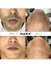 ナークス(NARX)/【ヒゲ脱毛】ビフォーアフター