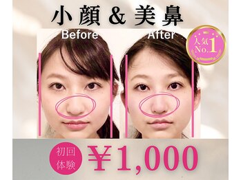 ラプリ 梅田店(Raplit)/隆鼻+輪郭矯正40分10回