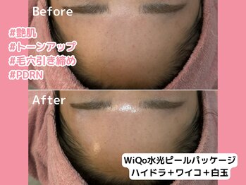 エンクリニカルラボ 三宮店(E&N CLINICAL LABO)/WiQo水光ピールパッケージ