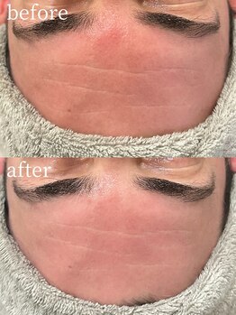 ラ フォルポ 恵比寿(La forepos)/乾燥赤み/おでこしわ改善/しわ