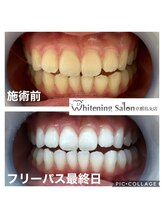 ホワイトニングサロン 京都烏丸店/ホワイトニング施術例
