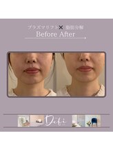 デフィ(Defi)/お顔の脂肪　ビフォーアフター