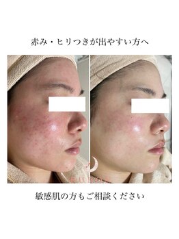 ルボン 宮崎店(RUBON)/敏感肌の方もご相談ください☆