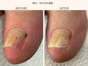 割れ・欠け爪の補強ケア