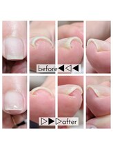 ミミカケルソラ(mimi×sora)/巻き爪補正☆