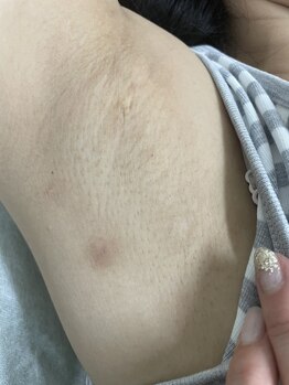 ナノハナ/鹿沼市の全身脱毛のナノハナ