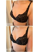 美バストアルファ(美bust α)/【バストアップ】症例