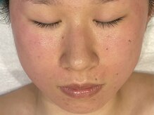 オアシスラグーン(OASIS LAGOON)/ニキビケア（症例４：after）