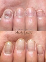 マリーロール 淀屋橋本店(Marie Laure)/自爪育成/深爪矯正/ネイルケア