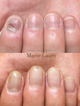マリーロール 淀屋橋本店(Marie Laure)/自爪育成/深爪矯正/ネイルケア