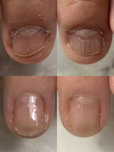 ハッチネイル(HACCI nail)/お客様BEFORE/AFTER