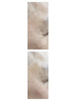 トリアングル(TLIENGLE)/ララピール before after