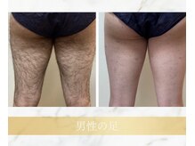 アンド エヌ(&n)/◆足脱毛◆