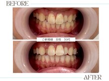 ホワイトニングサロンブライト 尼崎店(Whitening salon bright)/回数を重ねて白い歯に♪