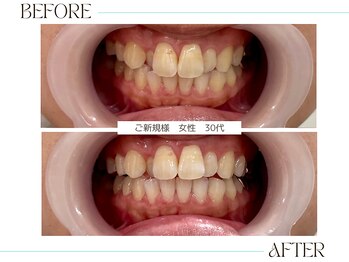 ホワイトニングサロンブライト 尼崎店(Whitening salon bright)/回数を重ねて白い歯に♪