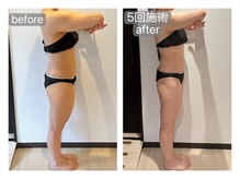 リラ(RILA)/キャビ+マッサージbefore after