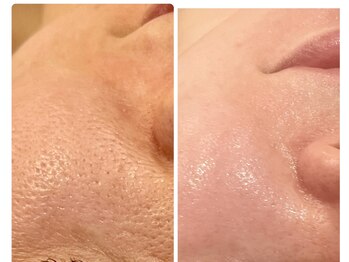 ミピブ 梅田(mipibu)/毛穴悩みに(梅田韓国式肌管理)