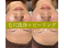 レアマカナ(LeaMakana)の雰囲気(【毛穴洗浄+ピーリング】ビフォーアフター)