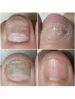 爪の悩みを解消できる（ケア含む）