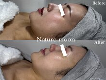 ナチュールムーン(Nature moon.)/ハーブピーリング