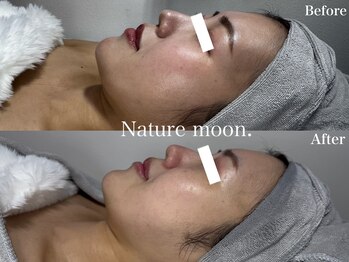 ナチュールムーン(Nature moon.)/ハーブピーリング