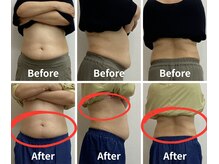 Noa接骨院 はりきゅう院/脂肪冷却　B/A写真