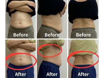 Noa接骨院 はりきゅう院/脂肪冷却 B/A写真