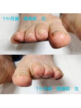ドクターネイル爪革命 長野店/【巻き爪ケア】ネイル/フット