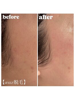 ウィンクドール(Wink Doll)/フェイシャルワックス脱毛☆