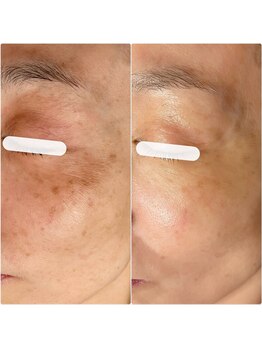 ティーツリー 名古屋 桜山(Tea Tree)/エステでシミケアができる！