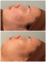 ビオエル 横浜店(Bioel)/ハーブピーリング/横浜