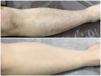 カルム(Calme)/男性 足WAX脱毛 30代