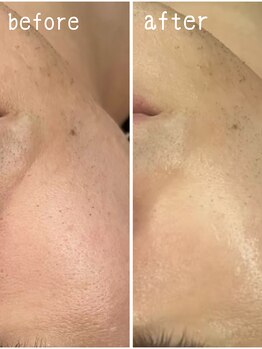 クーレ(CURE)/最強肌改善プラズマジェット