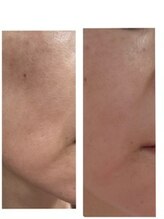 キヨラビューティー/光フェイシャル＋肌質改善