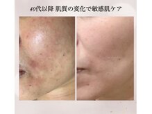 年齢と共に肌質が変わってきた。そんなお悩みの方へ