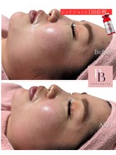 フォトビズ/レッドショットで二重顎解消！